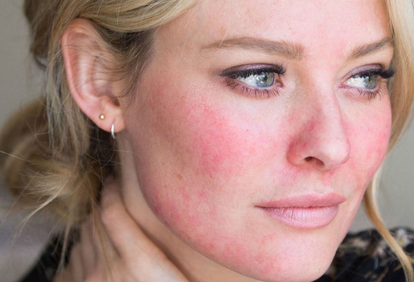 Обветрило кожу лица: что делать и как избежать проблем obvetrilos-lico