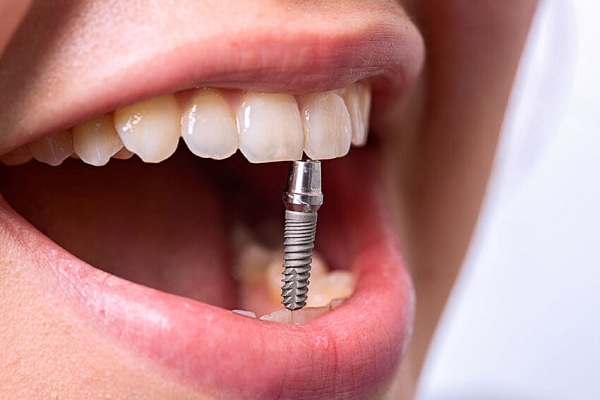 Имплантация зубов недорого