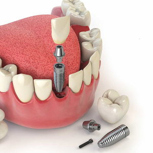 Технология имплантация зубов