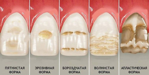 Гипоплазия зубной эмали: причины и симптомы