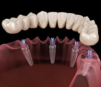 Этапы протезирования зубов