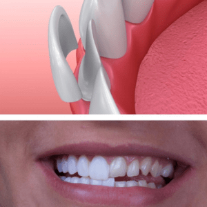 Установка виниров на зубы: разбор процедуры поэтапно
