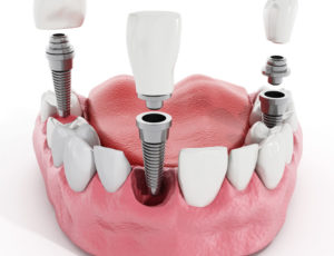 Имплантация зубов: как происходит операция?