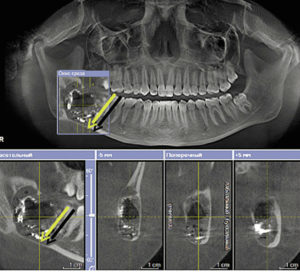 Переход от аналогового к цифровому рентгеновскому излучению в стоматологии