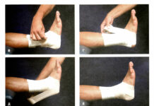 Как правильно накладывать эластичный бинт?