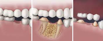 Протезирование зубов: в чем опасность беззубой жизни?
