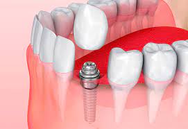Имплантация зубов: современный метод восстановления утраченных зубов