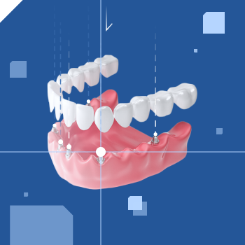 Цифровая имплантация зубов: залог успешного протезирования