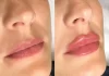 Как проходит процедура по увеличению губ гиалуроновой кислотой?