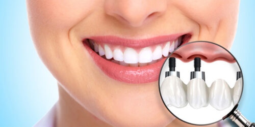 Улучшите улыбку и качество жизни: протезирование зубов в современной стоматологии
