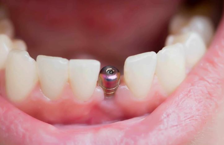 Имплантация зубов: восстановление зубного ряда с помощью искусственных титановых корней
