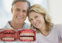 All-on-4 — революция в стоматологии: от беззубой улыбки к голливудской