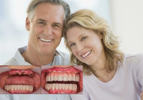 All-on-4 — революция в стоматологии: от беззубой улыбки к голливудской