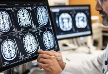 Врач раскрыл скрытые признаки опухоли мозга, на которые редко обращают внимание